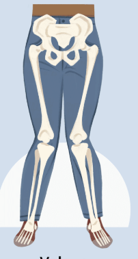 <p>Valgus </p>