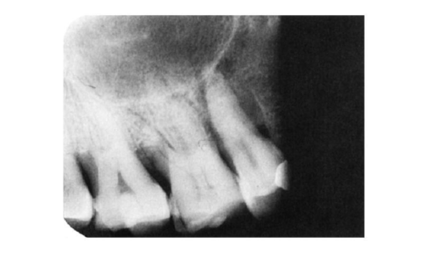 <p>-Fixer level too low to cover the entire film = the developer will continue to darken the image</p><p>-Partial image: Fixer is too low to cover entire film</p>