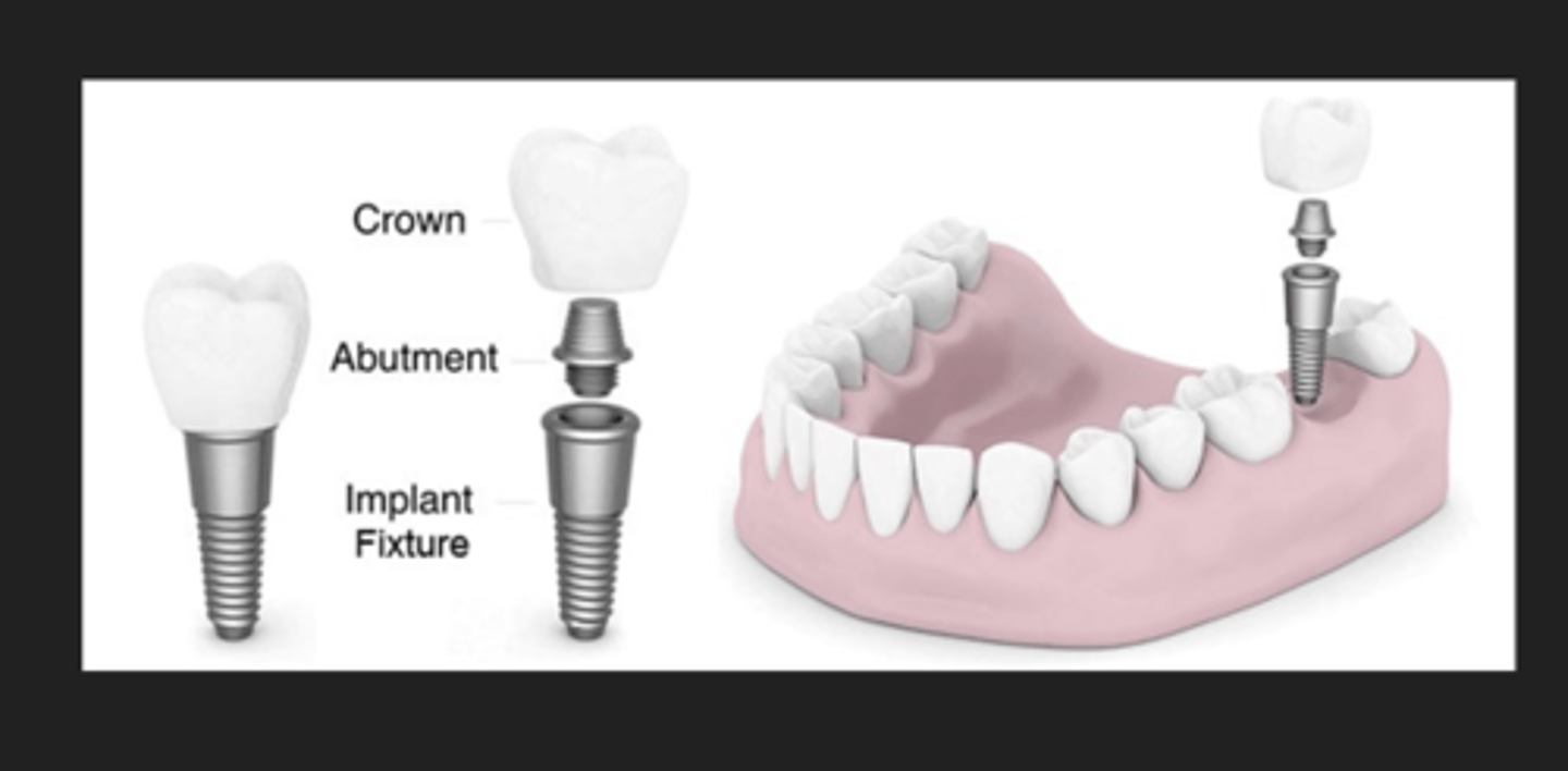 <p>crown, abutment, implant fixture/body</p>