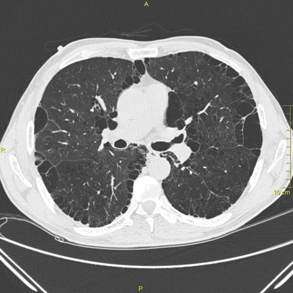 <p>Cause: Long-term smoking, air pollution, genetic factors (e.g., α1-antitrypsin deficiency). ECM Destruction: Elastin and collagen degradation in alveolar walls due to elastase overactivity, leading to emphysema and airway collapse.</p>