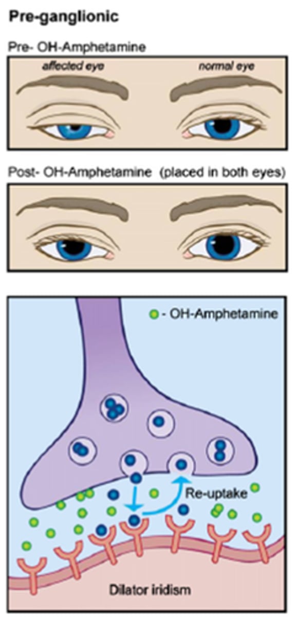 <p>healthy, normal eye = lots of NE = hydroxyamphetamine forces lots of NE into the NMJ = pupil dilates</p>