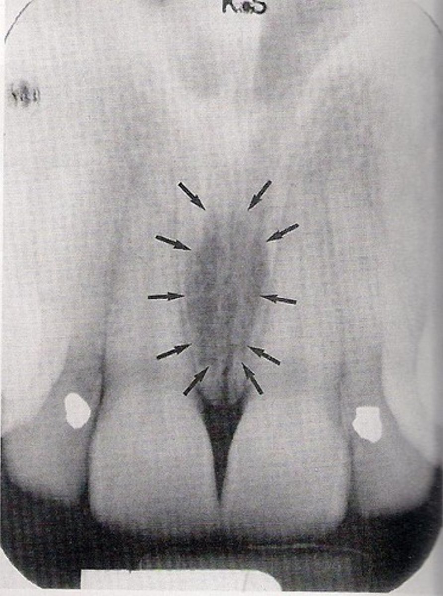 <p>Radiolucent; Oval shaped between the apices of the central incisors</p>