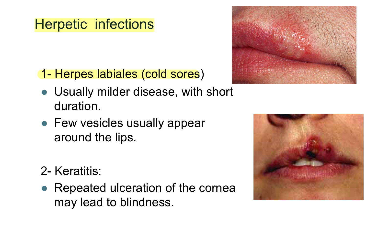 <ul><li><p>Herpes Simples Virus-1 infection</p></li></ul><p></p>
