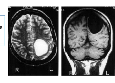 <p>patient has large left hemisphere cyst, causes her to experiencing vanishing arm on ___ side, unabel to identify items by touch on that side, if limb is touched however she is able to be aware of its position and can regain limb by using vision </p>