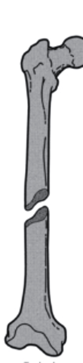 <p>what is the direction of this fracture line?</p><p>a. transverse</p><p>b. longitudinal</p><p>c. oblique</p><p>d. spiral</p>