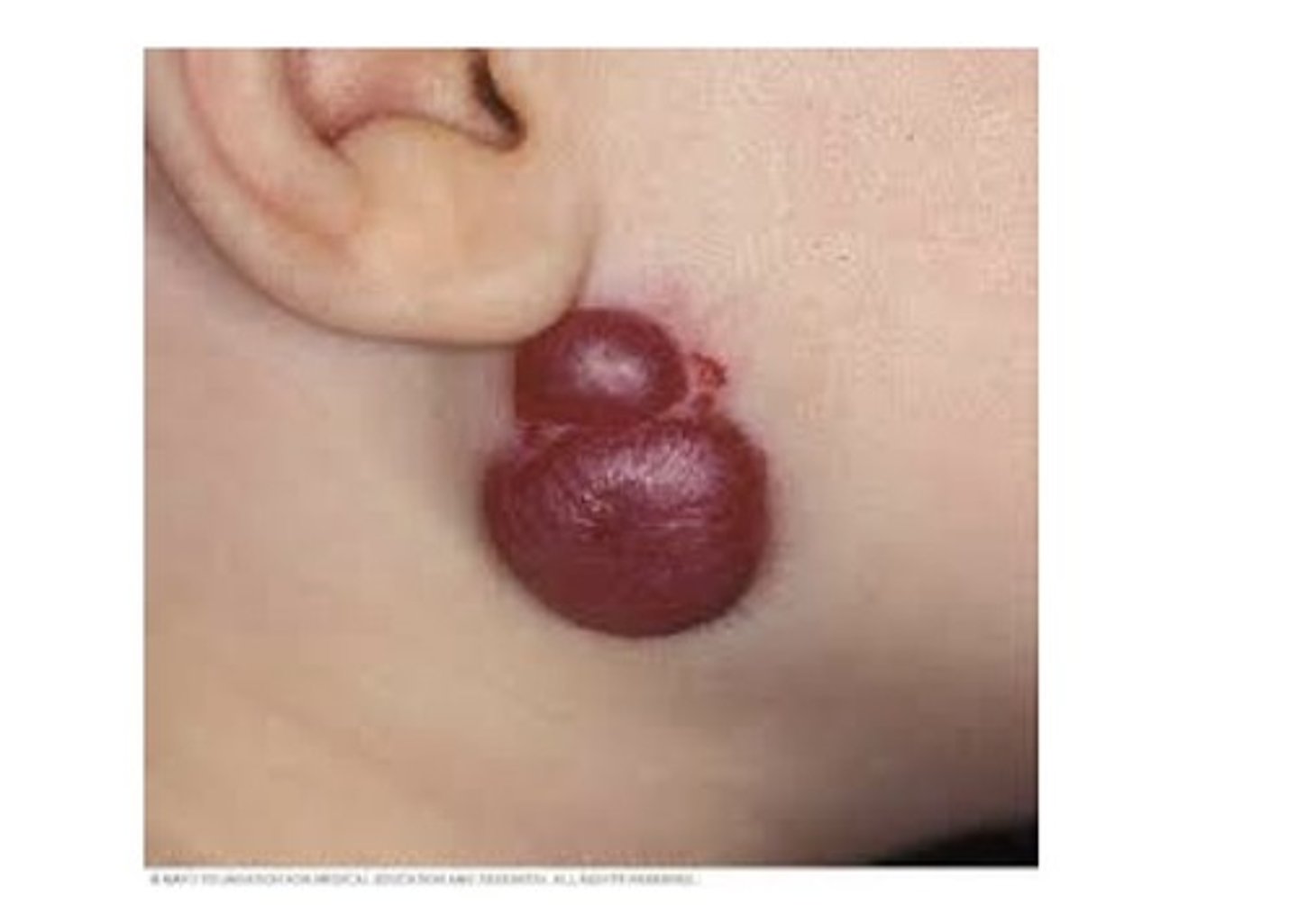 <p>Sometimes called a birthmark, raspberries, strawberries. A benign proliferation of capillaries. A capillary ———————: contains numerous small capillaries. A cavernous ———————: contains larger blood vessels. Most are present at birth or arise shortly after. Most commonly in the head and neck area, tongue is the most common intraoral location. More common in females, may occur in adults in response to trauma.</p>