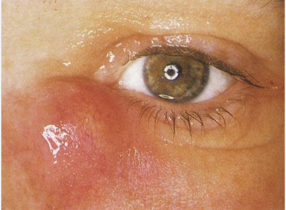 <p>Patient presents to the ER with a red, swollen mass under the eye. On a physical exam you note the lacrimal sac is warm to the touch and tender on palpation. You note purulent discharge. What do we need to order? What are we thinking?</p>