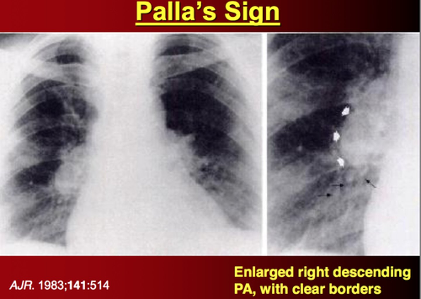 <p>Palla's sign</p>