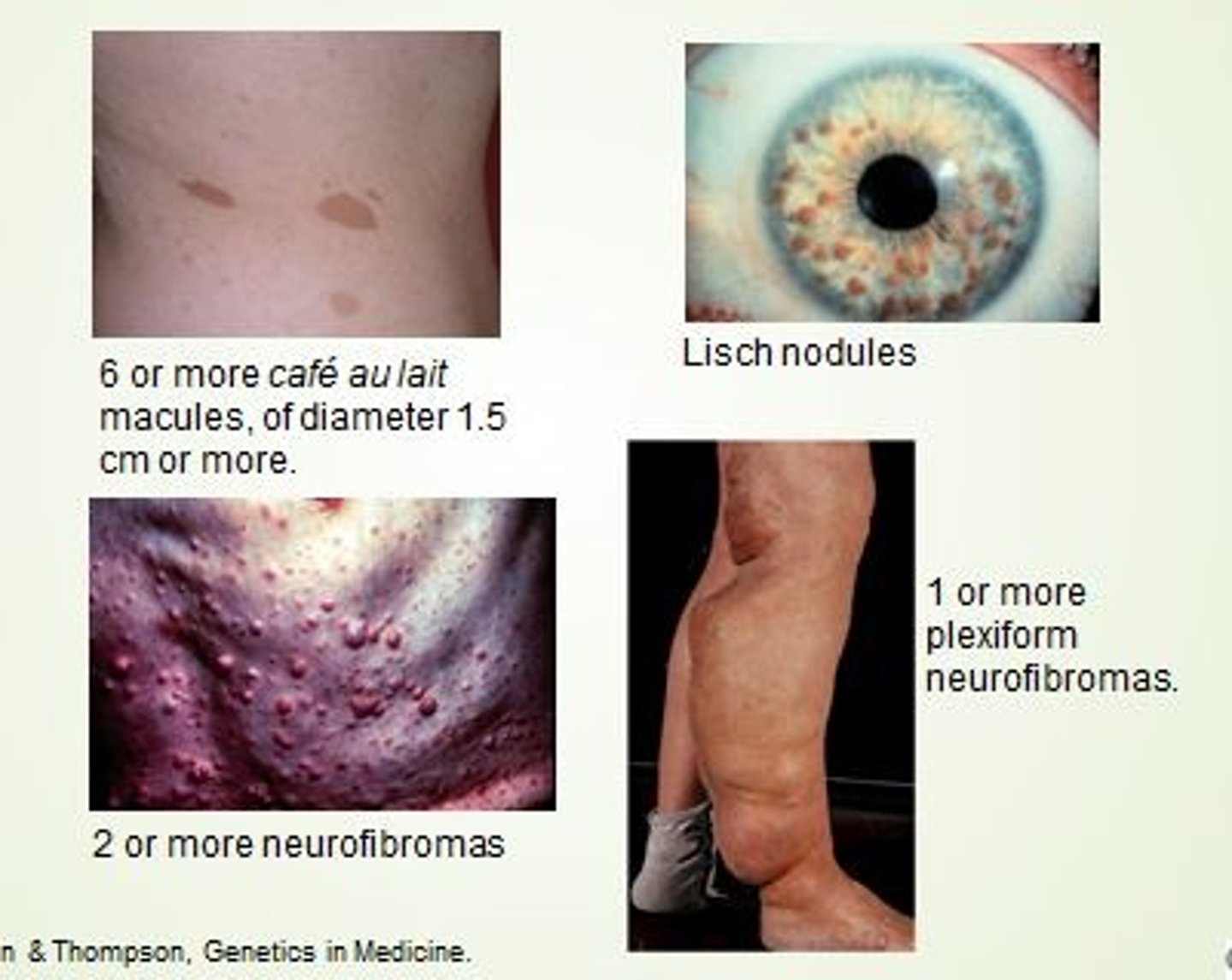 <p>Neurofibromatosis Type I, pheochromocytoma, optic gliomas</p>