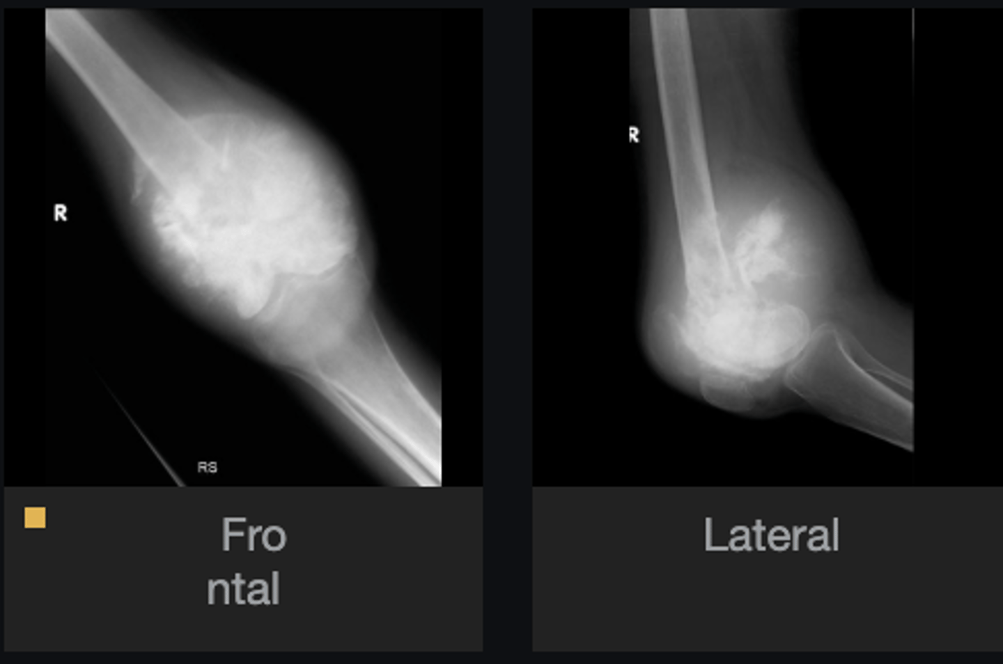 <p>Soft tissue involvement</p>