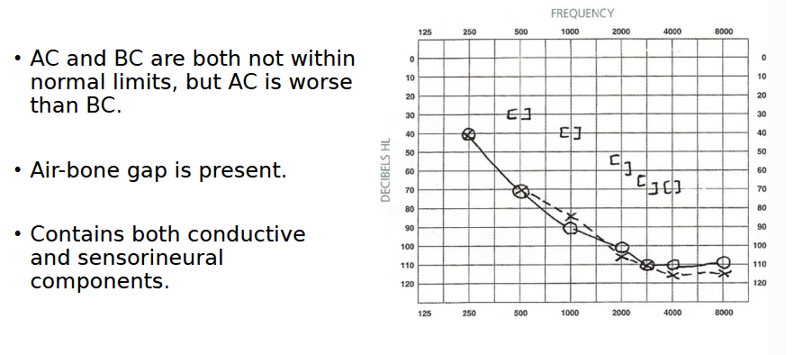 <p>“Mild precipitous sloping to profound mixed hearing loss bilaterally”</p>