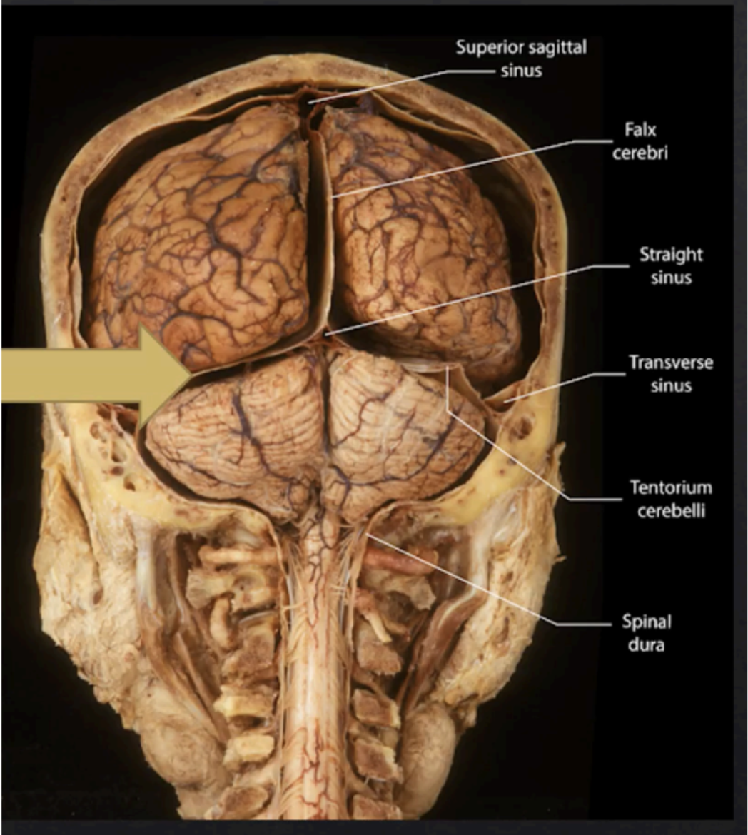 <p>Tentorium Cerebelli</p>
