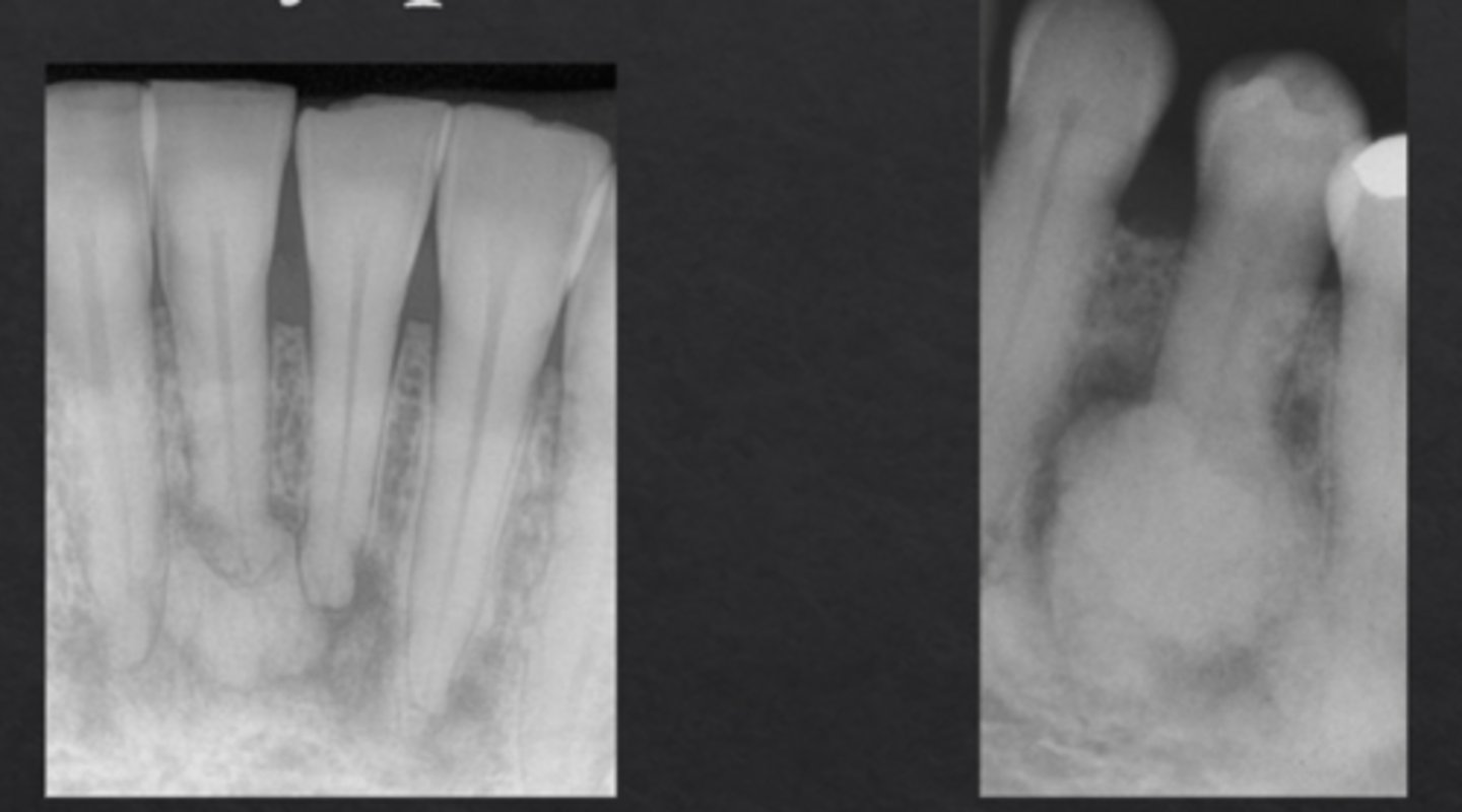 <p>Localized bone dysplasia that becomes more calcified over time</p>