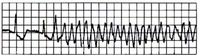 <p>Re-entry can occur causing a series of rapid uncoordinated excitations</p><p>These rapid un-coordinated excitations are collectively referred to as ventricular fibrillation (VF)</p><p>There is no cardiac output during VF</p><p>Death follows within minutes</p><p>(Normally, an electrical impulse travels through the heart tissue once, then stops (because the cells behind it are refractory). In re-entry, the impulse doesn't stop — it circles back into areas that are no longer refractory and keeps re-exciting the tissue.)</p>