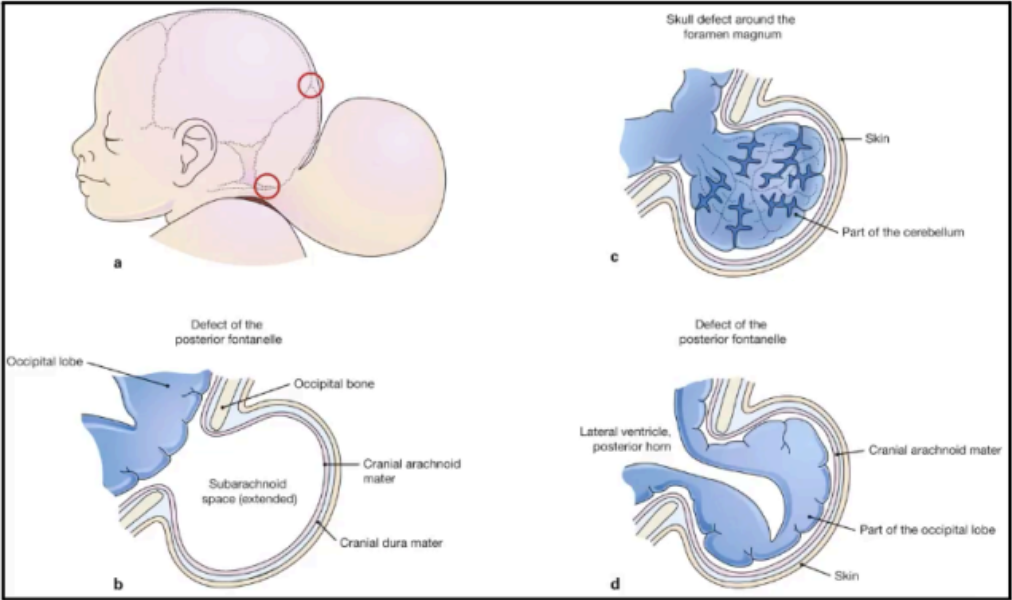 <p>CRANIUM BIFIDUM</p>