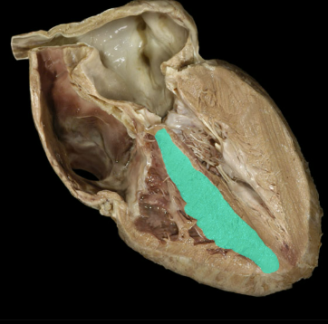 <p>Interventricular septum</p>