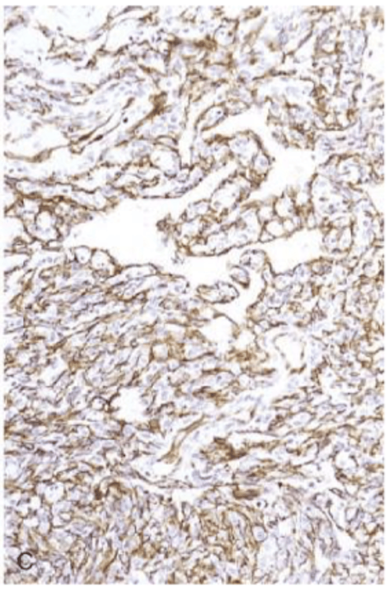 <p>endothelial origin</p><p>angiosarcoma</p>