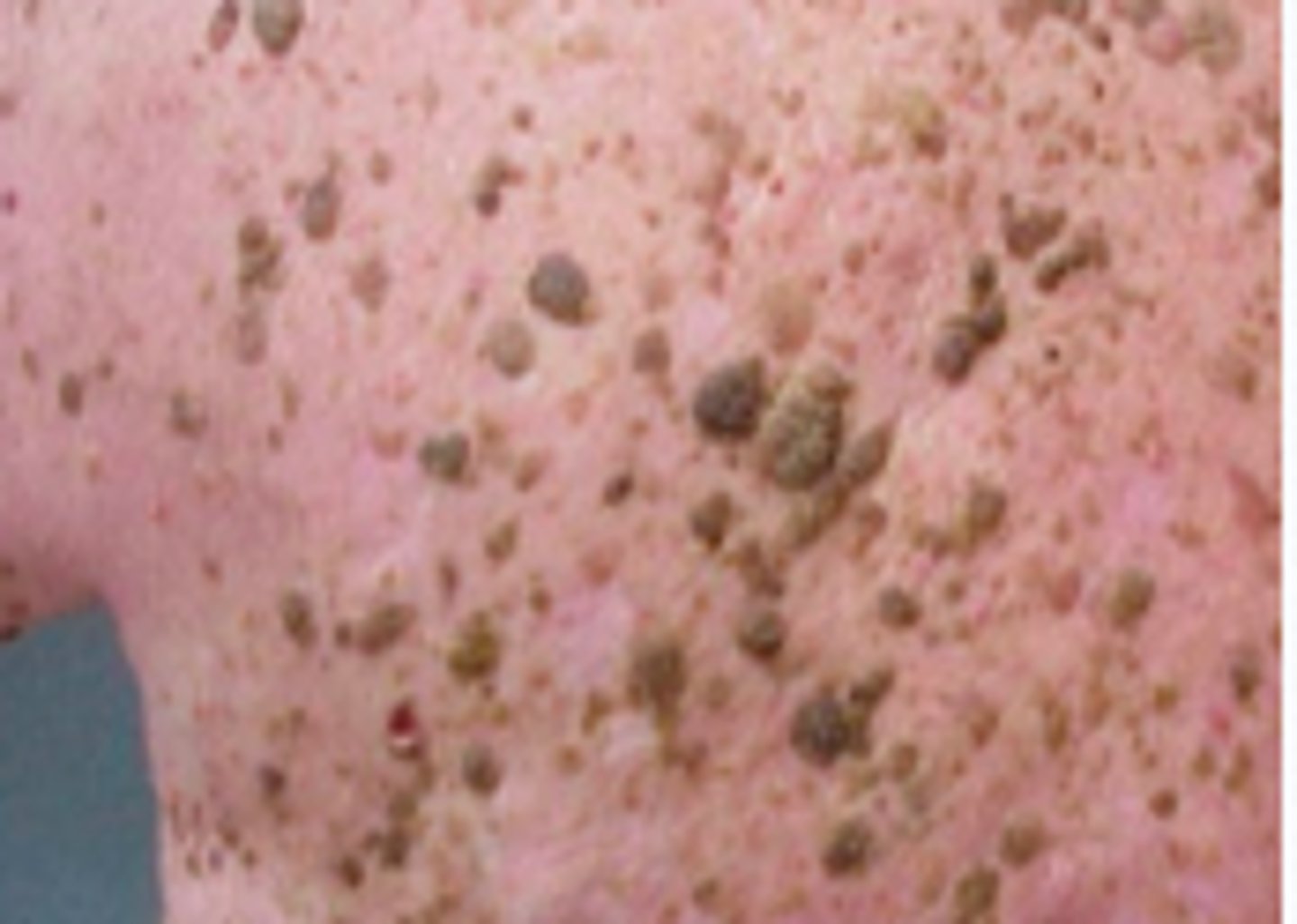 <p>Keratotic Disorders:</p><p>Overview:</p><p>- Most common benign tumor in older individuals</p><p>- No specific etiological factors have been identified</p><p>Subjective:</p><p>- Usually asymptomatic, but can be an annoyance</p><p>- Can itch/rub/catch on clothing and become inflamed</p><p>- Mostly worried they could be malignant</p><p>- Sometimes a person can have many of these and not notice a dysplastic nevus or malignant melanoma that develops among the seborrheic keratoses.</p>