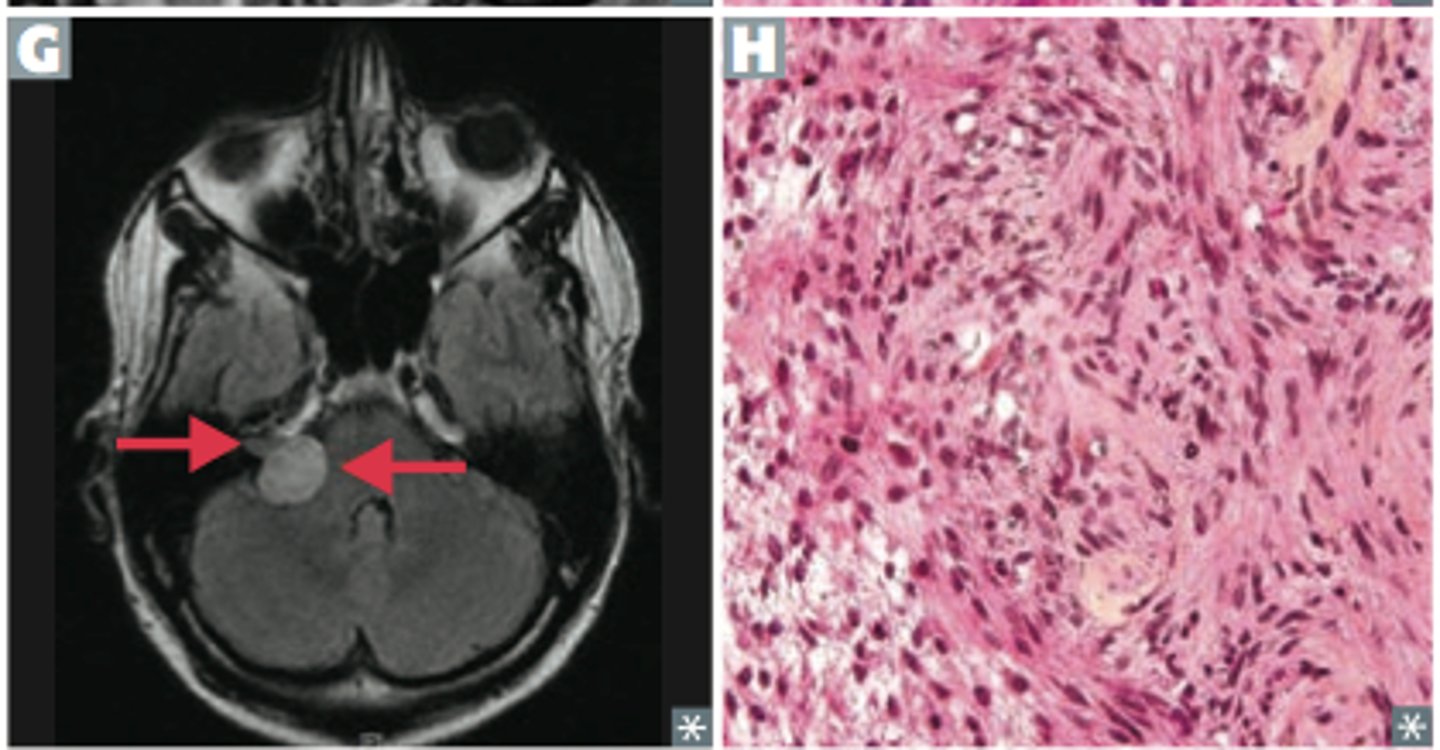 <p>Neurofibromatosis type 2</p><p>occur in cerebellopontine angle, S100 marker</p>