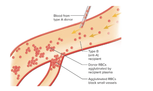 <p>Because otherwise clumping can happen</p><ul><li><p>Each antibody can attach to several foreign antigens on several different RBCs at the same time</p></li><li><p>Responsible for mismatched transfusion reaction</p></li><li><p>Agglutinated RBCs block small blood vessels, hemolyze, and release their hemoglobin over the next few hours or days</p></li><li><p>Hb blocks kidney tubules and causes acute renal failure</p></li></ul><p></p>