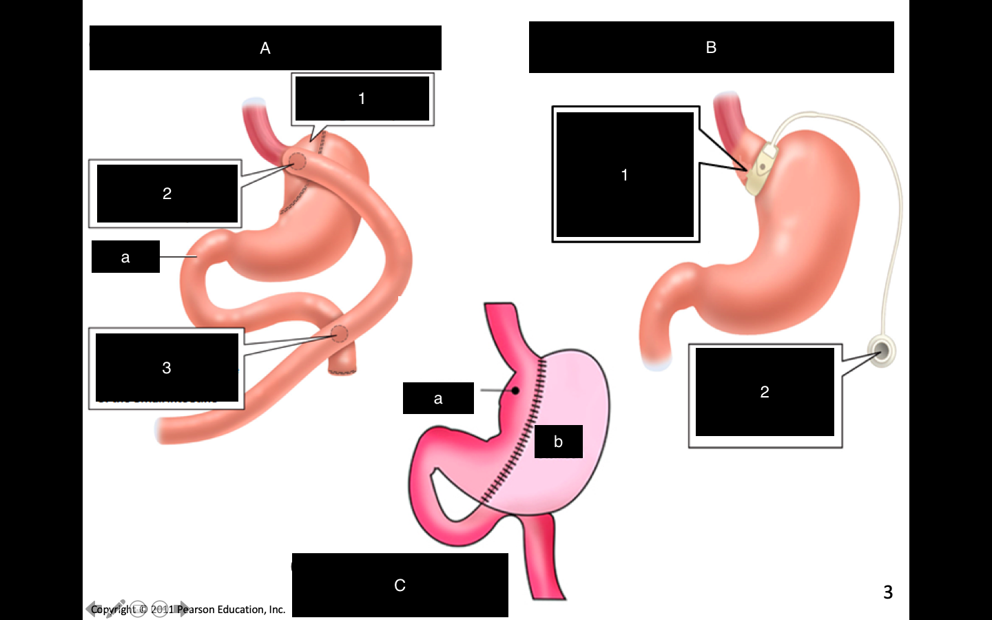 Benefits of this procedure?  Lifestyle changes?
Individ who have gastric surgery loose weight permanently?