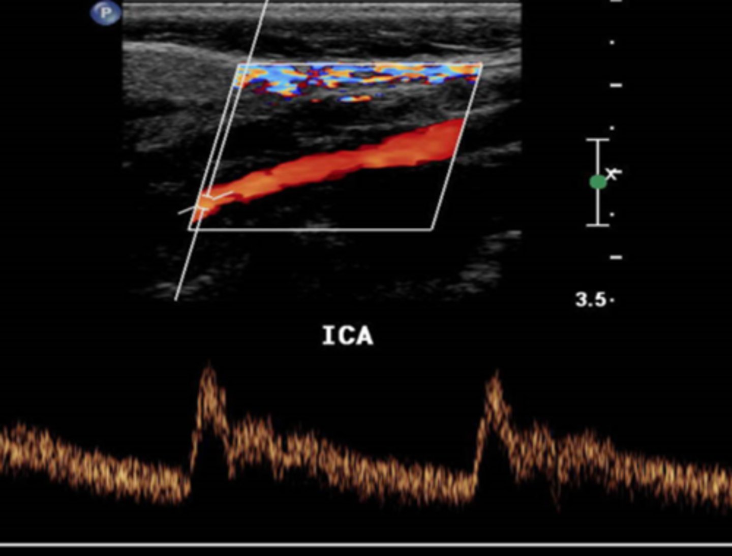 <p>blood flow is forward during both systole and diastole</p>