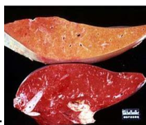 <ul><li><p>Excessive fat accumulation in the liver leading to liver dysfunction </p></li></ul><p>Causes: </p><ul><li><p>often secondary to hyperlipemia, starvation, or anorexia </p></li><li><p>negative energy balance <strong>during late pregnancy. </strong>pregnancy toxemia (ketoacidosis) </p></li></ul><p>Clinical signs: </p><ul><li><p>similar to hyperlipemia (lethargy, anorexia, weakness) </p></li><li><p>jaundice (yellowing of mucous membranes) </p></li><li><p>neurological signs due to liver failure (hepatic encephalopathy) </p></li></ul><p>Diagnosis: </p><ul><li><p>bloodwork: elevated liver enzymes (AST, GGT) bilirubin, and bile acids </p></li><li><p>ultrasound: enlarged, hyperechoic liver </p></li><li><p>liver biopsy: confirms fat accumulation in liver cells </p></li></ul><p>treatment: </p><ul><li><p>dietay management provide a high quality energy rich diet hand feed if necessary </p></li><li><p>energy supplements: <strong>administer high energy drenches; </strong>several commericial products are avialble. <strong>propylene glycol is not advised (toxic) </strong></p></li><li><p><strong>gastric ulcer prevention </strong></p></li></ul><p>prognosis - poor to guarded especially if liver damage is severe. fatal if not recognized and treated aggressively within 2448 hours </p><p></p>