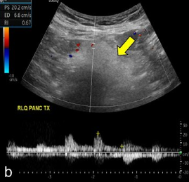 <p>Evaluate the arterial flow of this transplant pancreas.</p>