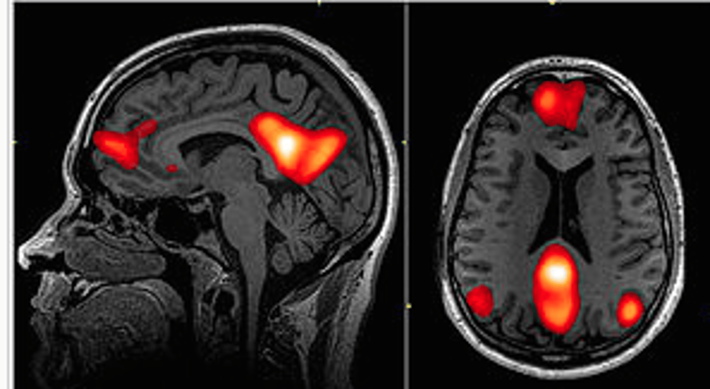 <p>Active brain state during rest and mind-wandering.</p>
