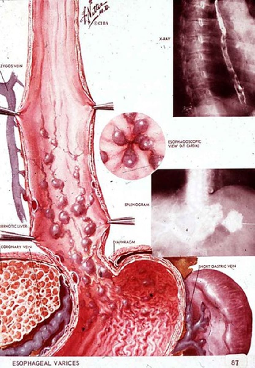 <p>abnormal, enlarged veins in the lower part of the esophagus that may lead blood or rupture</p><p>-> develops when normal blood flow to the liver is obstructed</p>