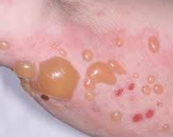 <p>what type of lesion is depicted and what condition</p>