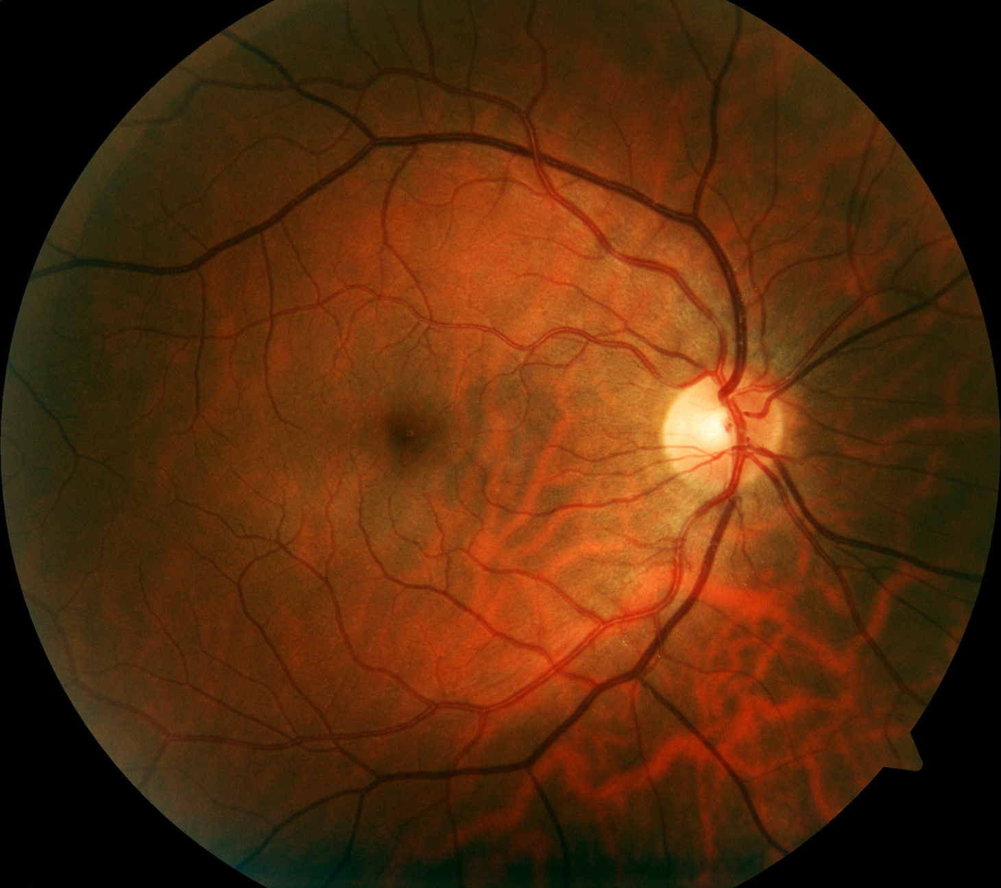 <p>point of entry for CN II that lacks photoreceptors and is insensitive to light; “blind spot”</p>