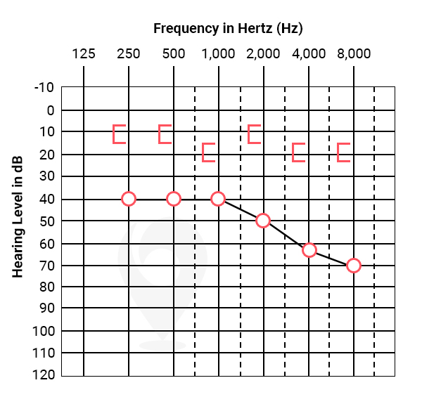 <p>(CHL) hearing loss is within the outer or middle ear - when there is a loss in air conduction but not bone conduction</p>