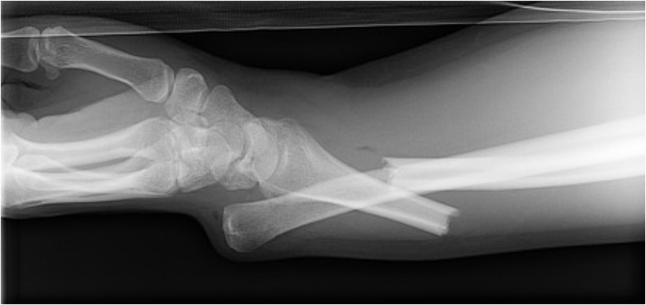 <p>fx of distal radius w/ dislocation of ulnar head from wrist </p>