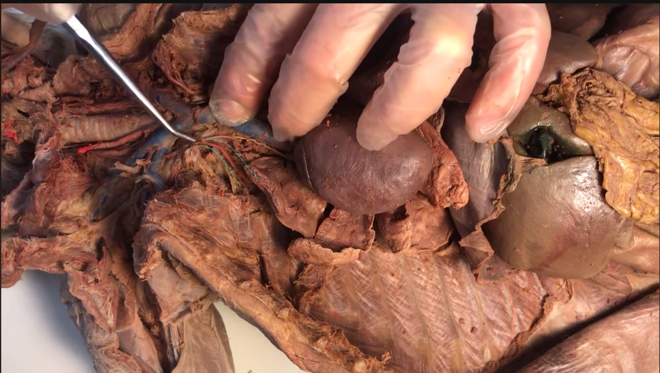 <p>What artery is this</p>