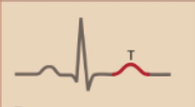 <p>T-wave</p>