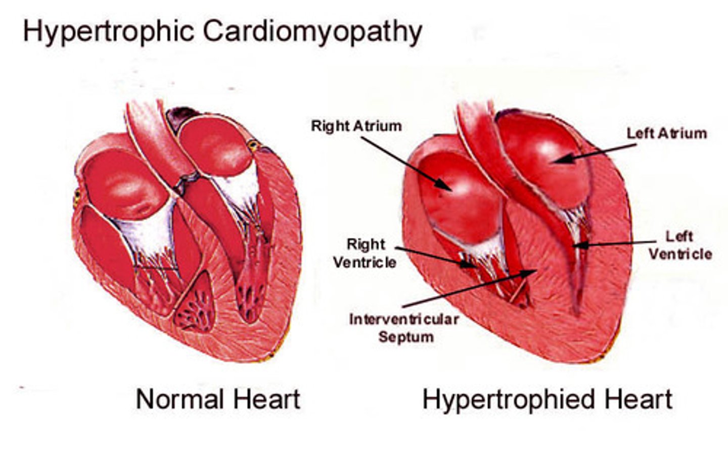 <p>-thickening of the heart muscle (often the intraventricular septum) that makes filling difficult and is a leading cause of sudden cardiac death</p><p>-the ventricle wall becomes stiff and unable to relax</p><p>-hence hypertrophy! an increase in the size of the heart!</p><p>-heart becomes scarred!</p>