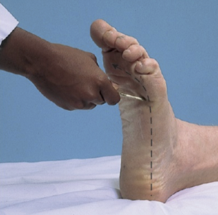 <ul><li><p>a type of superficial reflex: motor response when skin is stroked</p></li><li><p>use blunt edge of reflex hammer or pen to trace path from heel curved out to big toe </p></li><li><p>extended great toe when there is pressure applied to the lateral/distal plantar surface of the foot </p></li><li><p>plantar flexion of big toe is normal </p></li><li><p>document: plantar response is extensor/flexor, upgoing/downgoing toes </p></li><li><p>NOT Babinski positive </p></li><li><p>dorsiflexion of the big toe indicates positive CNS lesion affecting the corticospinal tract</p></li></ul><p></p>