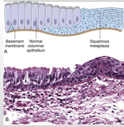 <p><span>Change in which one adult cell type is replaced by another adult cell type</span></p><ul><li><p><span>A cell type sensitive to a particular stress is replaced by another cell type better able to withstand the adverse environment</span></p></li><li><p><span>Example- respiratory epithelium in habitual cigarette smokers</span></p></li></ul><p></p>