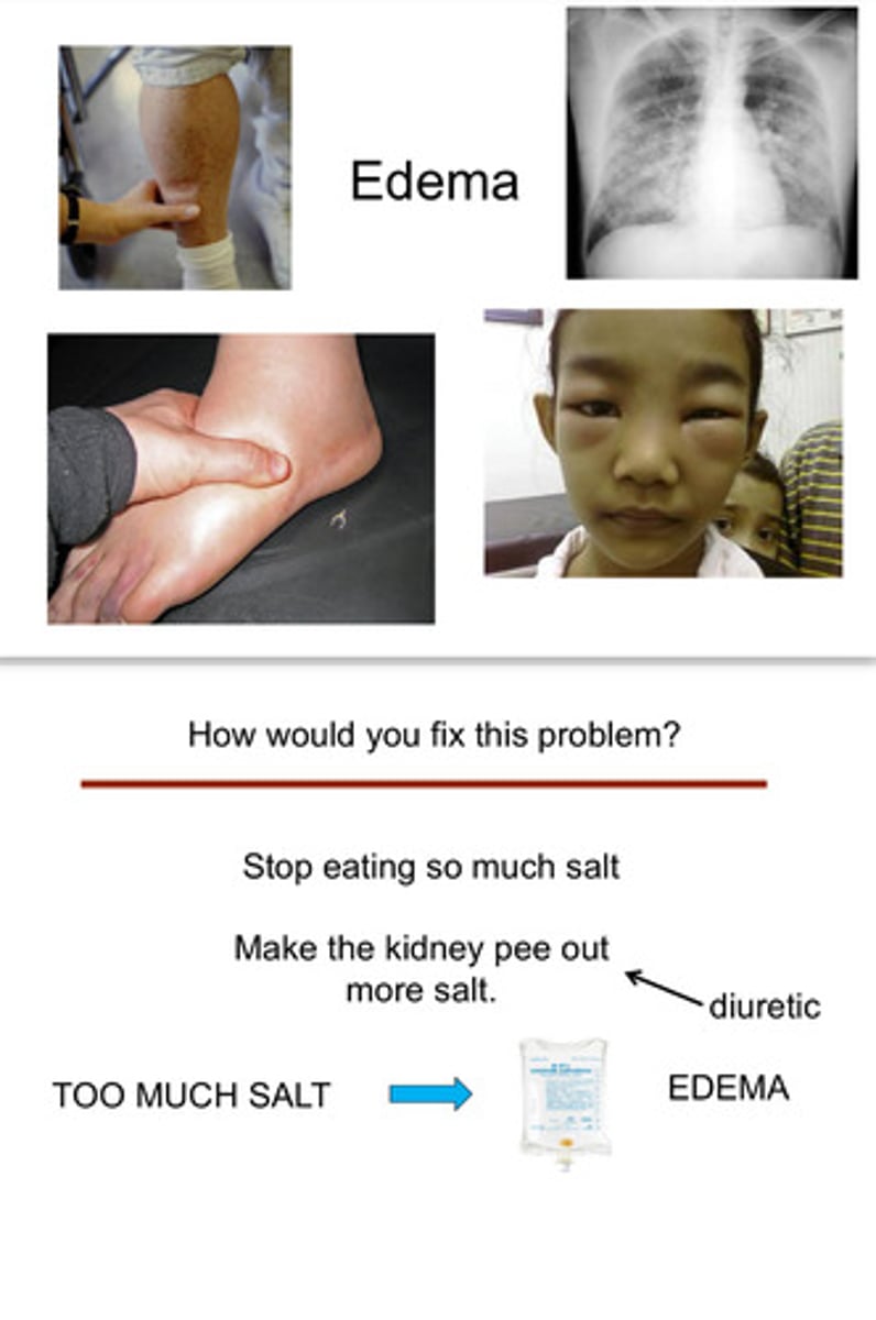 <p>edema means there is too much salt in the body (to fix this: stop eating so much salt or make kidneys pee out more salt)</p>
