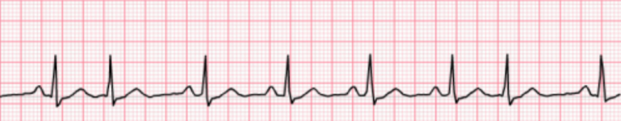 <p>Determine the Junctional dysrhythmia: </p><ul><li><p>rate: 60-100 bpm</p></li><li><p>rhythm is regular except for occurrence of premature beats </p></li><li><p>P waves are usually inverted; may occur before, during, or after the QRS complex of the premature beat</p></li></ul><p></p>