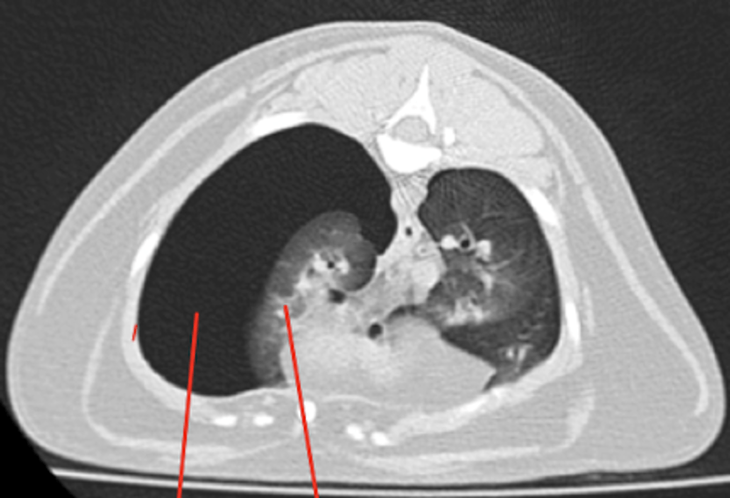 <p>espacio negro entre la pleura parietal y visceral, con pulmón atelectasico</p>