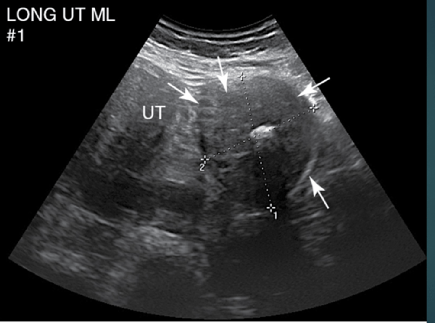 <p>Cause dyspareunia, dysuria, urinary urgency, obstruction, prolapse, bleeding</p>