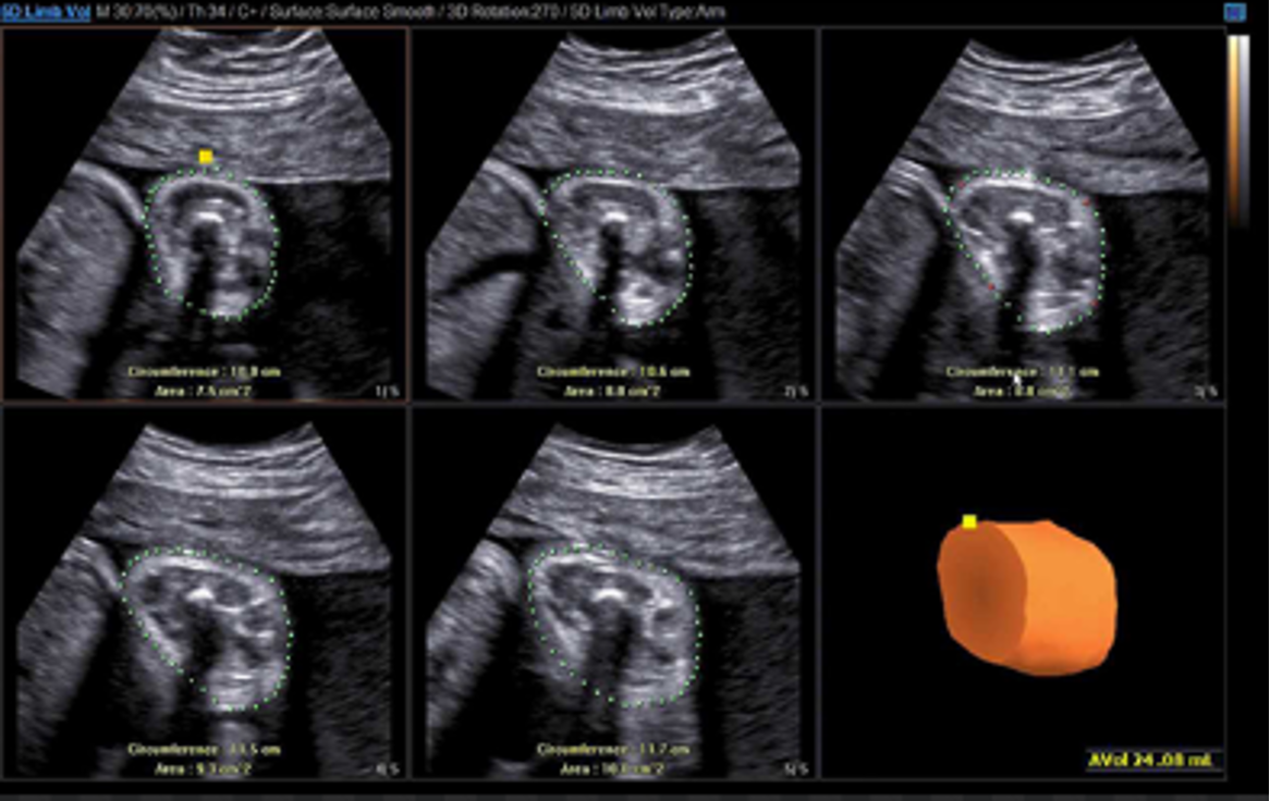 <p>measure thigh volume to assess soft tissue mass</p><ul><li><p>may be good indicator for fetal growth</p></li><li><p>strongly correlated with 2D assessments of fetal weight</p></li></ul>