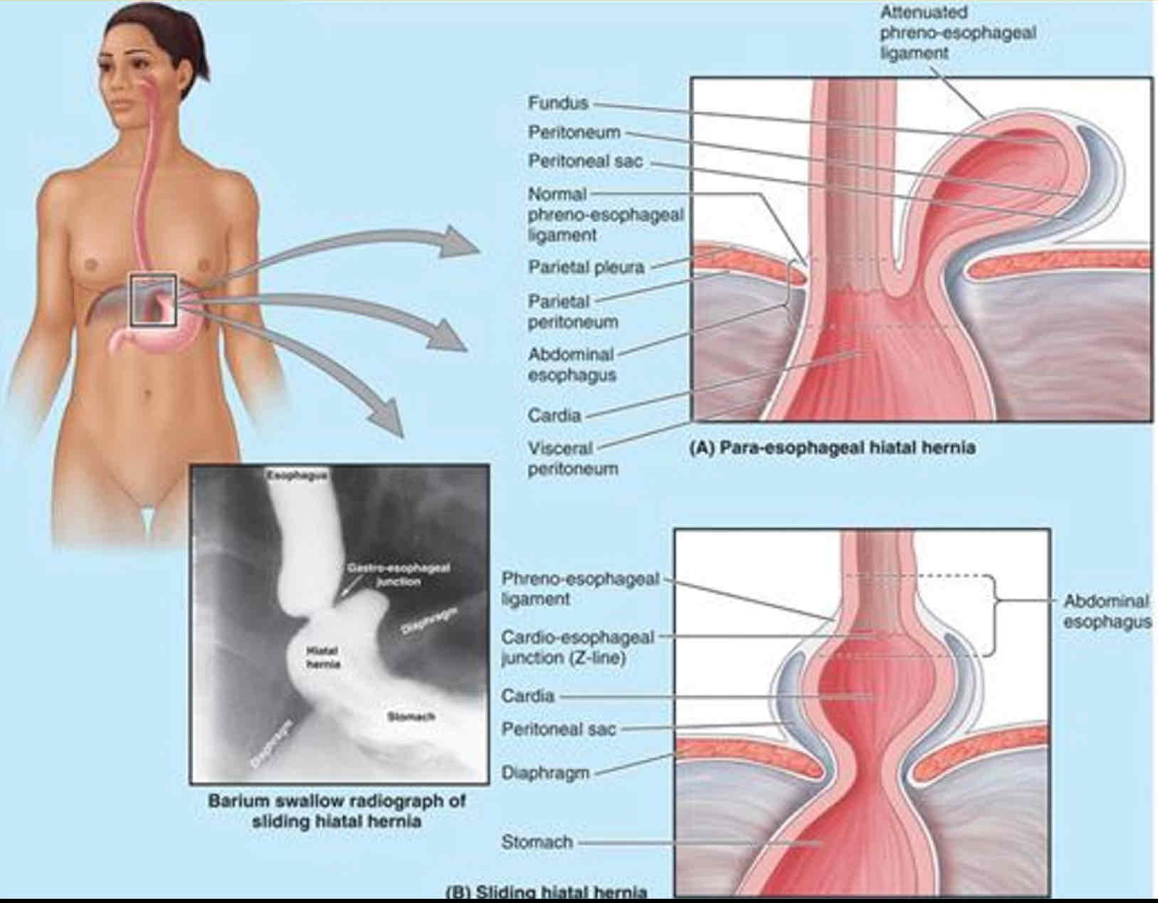 <ul><li><p>Para-esophageal</p></li><li><p>Sliding</p></li></ul><p></p>