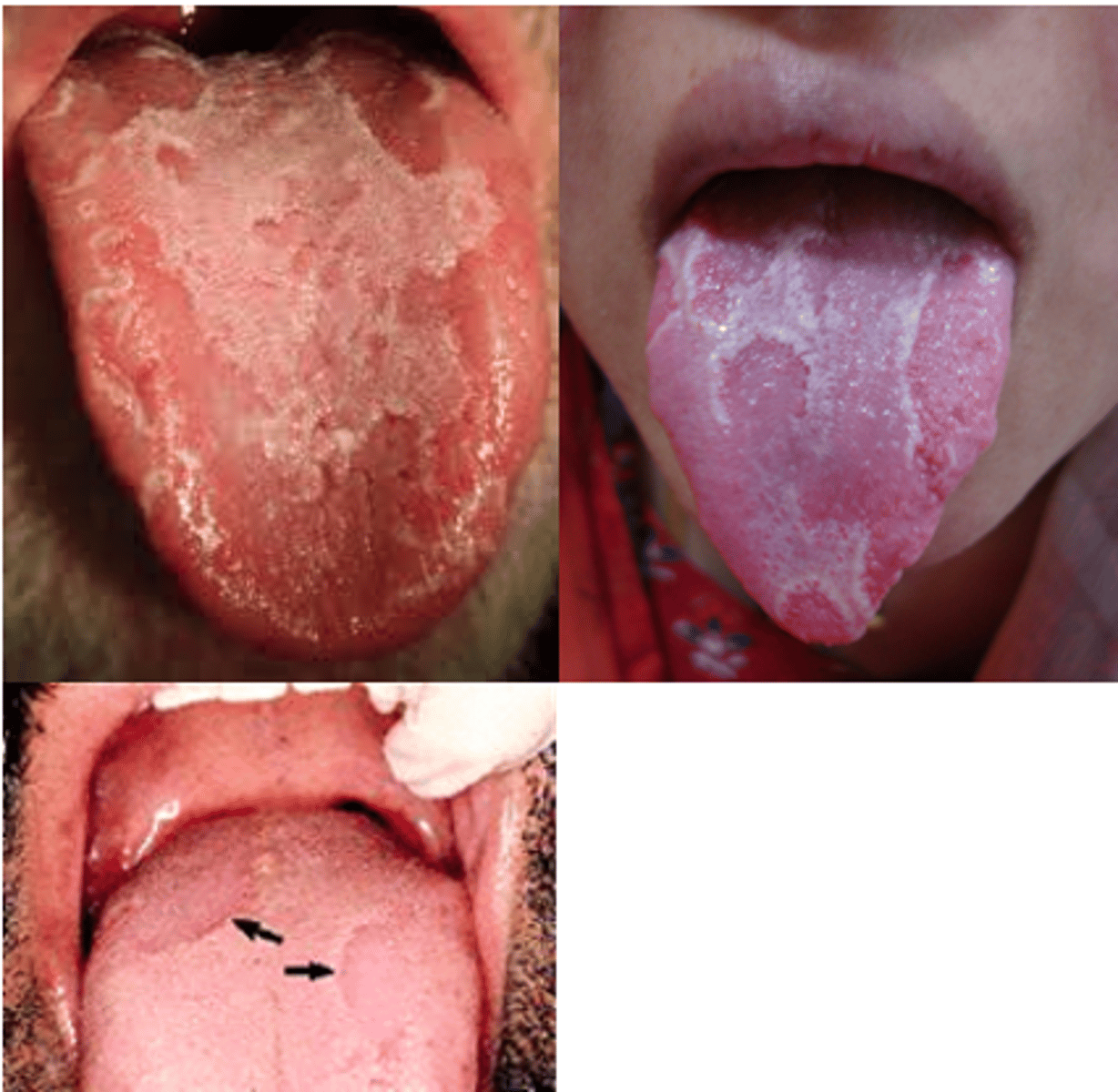 <p>Geographic tongue or Erythema migrans</p>