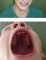 <p><span><strong>◦ High arched palate </strong></span></p><p><span><strong>◦ Mandibular prognathism </strong></span></p><p><span><strong>◦ Macroglossia </strong></span></p><p><span><strong>◦ Enamel hypoplasia </strong></span></p><p><span><strong>◦ Malocclusion </strong></span></p><p><span><strong>◦ Gingivitis </strong></span></p><p><span><strong>◦ Poor oral hygiene </strong></span></p><p><span><strong>◦ Medication-induced xerostomia</strong></span></p>