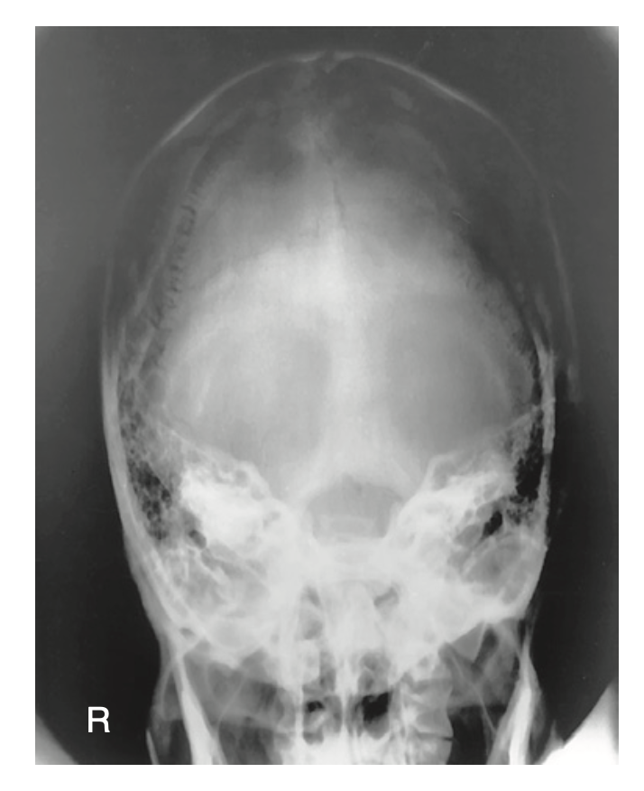 <p>How do you <u>critique</u> radiograph of <strong>AP axial projection of Towne’s</strong> method for <strong>skull</strong>?</p>