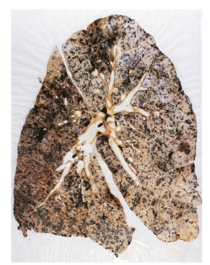 <ul><li><p>inhalation of mineral dusts, fumes, and various organic and inorganic particulate matter</p><ul><li><p>duration of exposure</p></li><li><p>size of particle/ larger filtered out</p></li><li><p>concentration and makeup</p></li><li><p>inflammatory response—&gt; fibrosis</p></li></ul></li></ul><p></p>