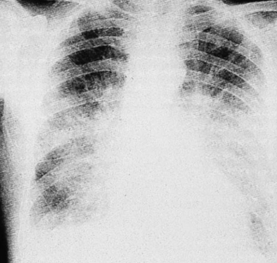 <p>Pulmonary oedema is a build-up of fluid in the interstitial space in the lungs. This increases the diffusion distance of gases between blood and the alveoli</p>